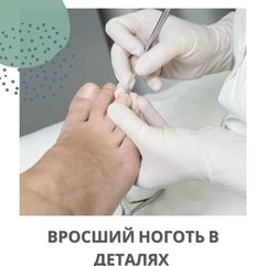 Вросший ноготь в деталях