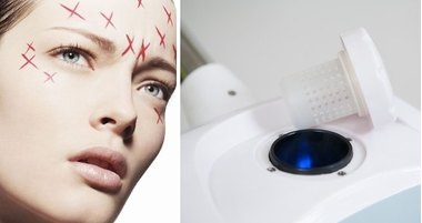 Вапоризатор – секрет идеальной кожи