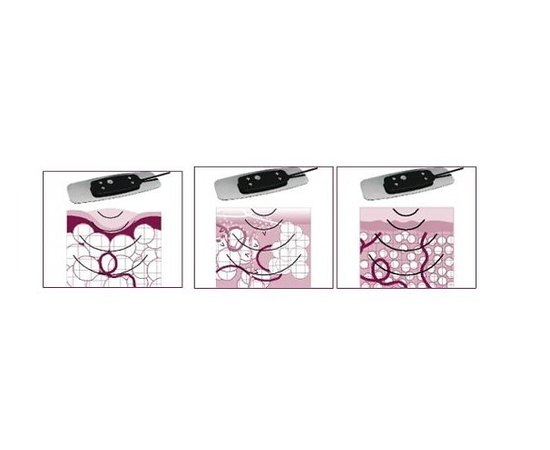 Апарат для кавітації ULTRASLIM, фото _ab__is.image_number.default