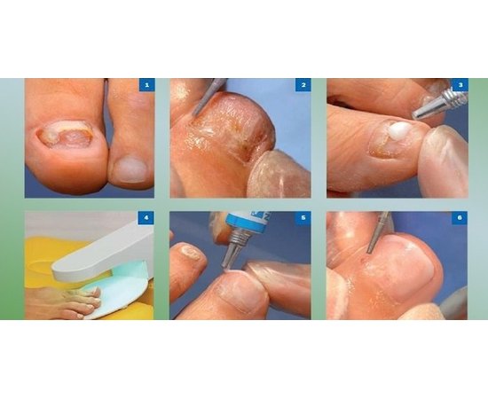 Восстанавливающий гель для протезирования Gehwol Nail Repair Gel, изображение 7