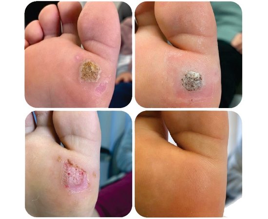 Паста для лечения бородавок Podopharm Verru Immuno Skin Care Paste, 12 ml, изображение 4